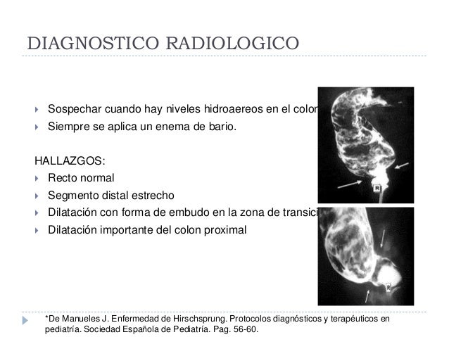 enfermedad de hirschsprung diagnostico